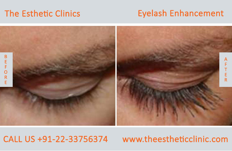 Eyelash Enhancement Surgery, Latisse Eyelash Treatment before after photos in mumbai india (3)